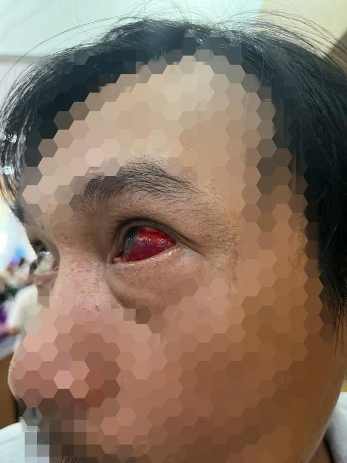 Bệnh nhân Đ. tới Bệnh viện Mắt Bình Tâm khám trong tình trạng mắt trái đỏ nhiều, vùng đỏ lan rộng.