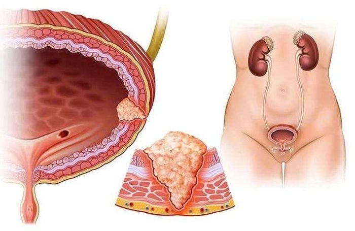 Ung thư bàng quang cần được chẩn đoán và phát hiện sớm.