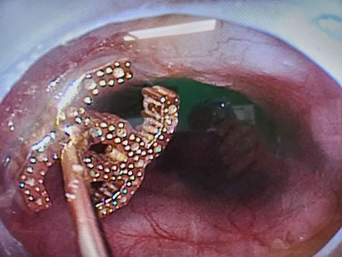 Dị vật bông tai được tìm thấy và đưa ra khỏi thực quản trẻ qua nội soi