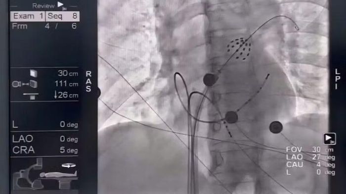 Hình ảnh catheter triệt đốt trong buồng tim, phát xung điện cô lập tĩnh mạch phổi.