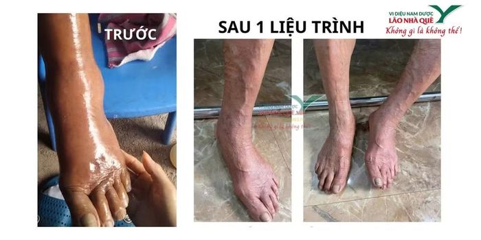 Chân cụ ông 89 tuổi trước và sau khi sử dụng phương pháp “Khai thông cột sống” của Lão Nhà Quê.