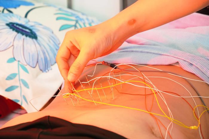Kỹ thuật điện châm được áp dụng trong điều trị cho bệnh nhân tại các cơ sở khám chữa bệnh - Ảnh: H.L