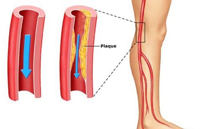 Tắc động mạch cấp chi dưới là một cấp cứu y khoa cần được xử trí trong "thời gian vàng"