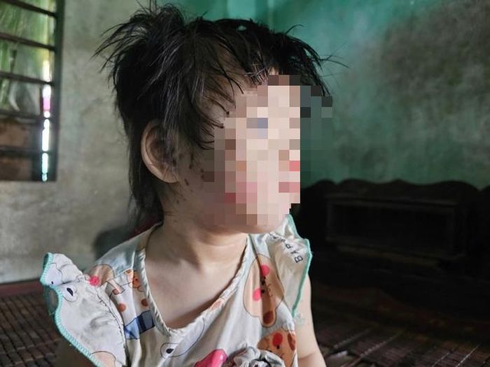 Trên mặt của cháu bé có nhiều vết thương.