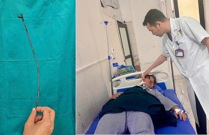 Hình ảnh mũi tên được lấy ra và bệnh nhân T. đang tiếp tục được theo dõi, điều trị. Ảnh: Thu Hòa.