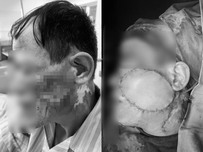  Ê-kíp đã nối vi phẫu hệ thống mạch máu nuôi vạt da nhằm đảm bảo nuôi sống mô ghép. 