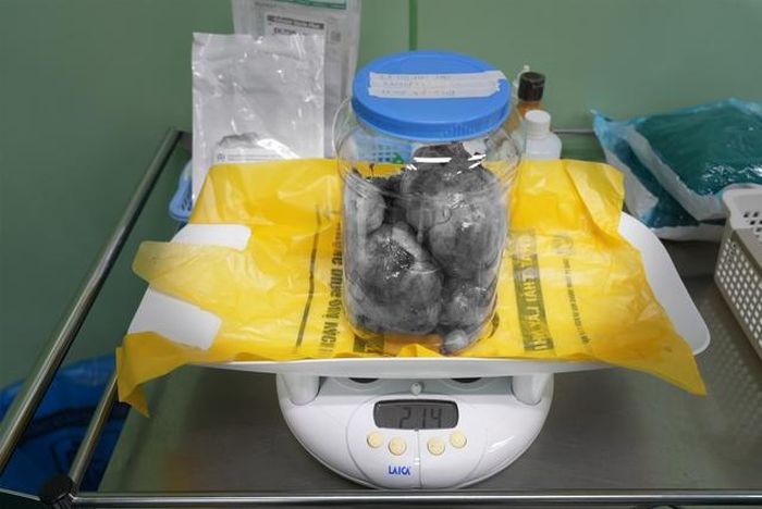 Bóc tách thành công 9 khối u xơ tử cung nặng 2,1kg.