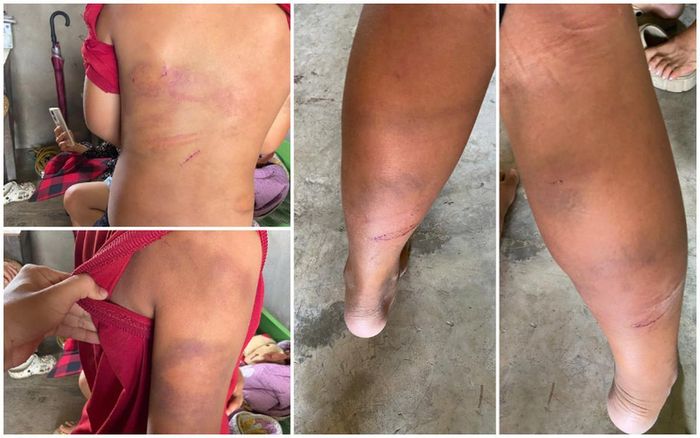 Những vết bầm tím được phát hiện khắp cơ thể của cháu U.