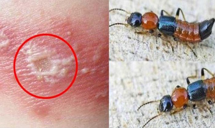 Vết tổn thương trên da do độc tố kiến ba khoang gây ra.