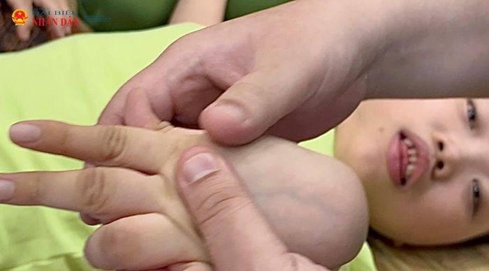 Biến chứng của căn bệnh bại não khiến đôi bàn tay nhỏ bé co quắp.