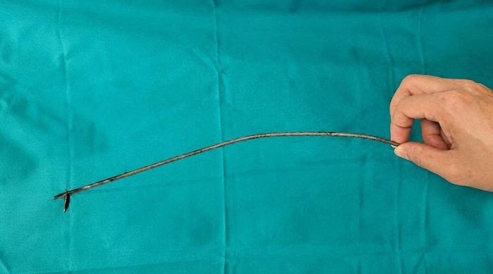 Mũi tên được các bác sĩ lấy ra an toàn sau ca phẫu thuật cấp cứu. Ảnh: BVCC
