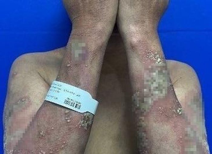 Tình trạng da của bệnh nhân khi nhập viện. 