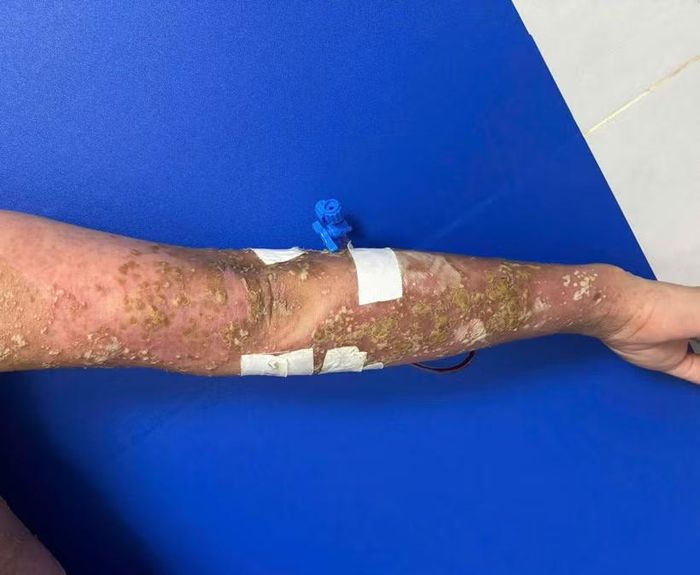 Cánh tay của bệnh nhân trước khi điều trị bằng phương pháp mới. (Ảnh: PV/Vietnam+)