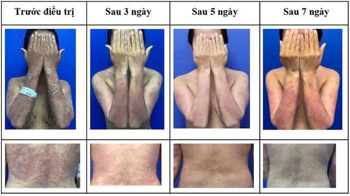 Hình ảnh bệnh nhân trước và sau 3, 5, 7 ngày điều trị.