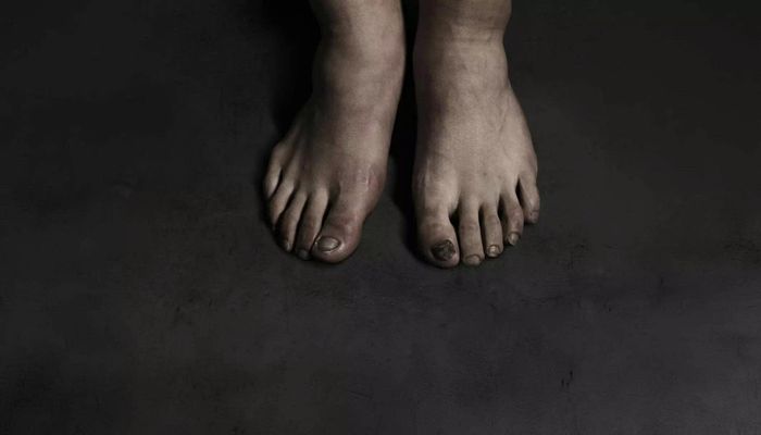  Đôi chân trần biến dạng, bầm tím vì tập luyện và thi đấu của Son Heung-min. Ảnh: JoongAng Ilbo. 