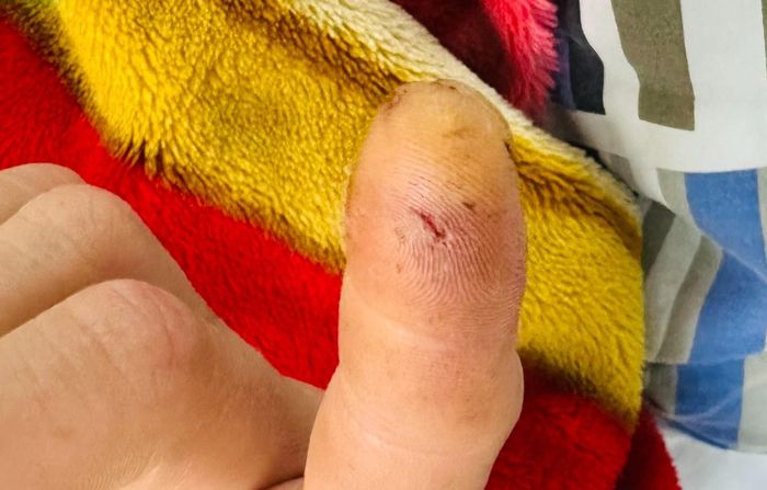  Culi cắn vào đầu ngón tay. Ảnh: BVCC. 