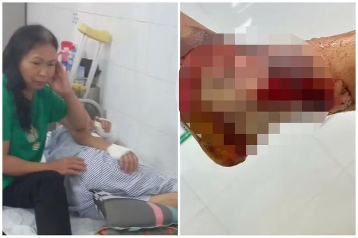 Người mẹ già nghèo khổ bất lực nhìn chân con trai đang bị hoại tử có khả năng phải cắt bỏ.