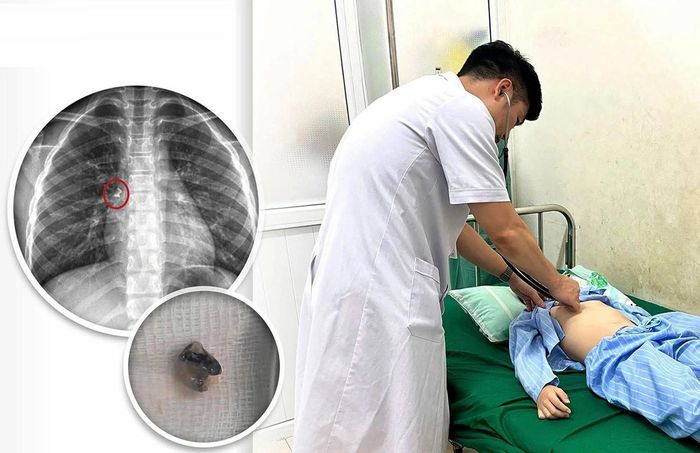 Bé trai hít sặc chiếc răng vừa được nhổ, dẫn đến ho sặc sụa và khó thở dữ dội, phải đi cấp cứu. Ảnh: BVCC