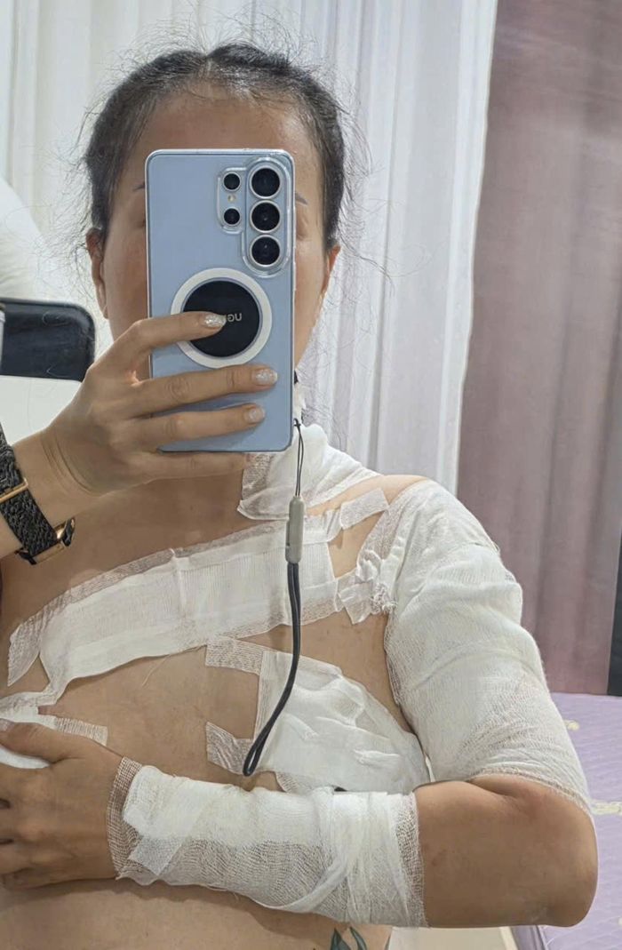 Chị Mai Anh bị bỏng khi sử dụng dịch vụ tại W. Spa (Khu đô thị Ocean Park, xã Gia Lâm, Hà Nội).