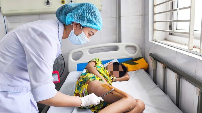 Bé N đang dần bình phục sau cuộc phẫu thuật và chờ đủ điều kiện để ghép xương.