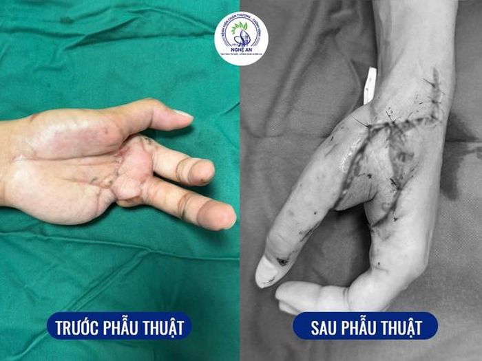 Hình ảnh trước và sau phẫu thuật chuyển vạt SCIP (Superficial Circumflex Iliac Perforator) tự do dưới kính hiển vi.