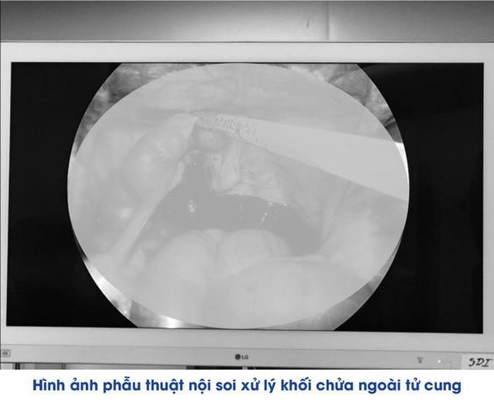 Hình ảnh phẫu thuật nội soi xử lý khối chửa ngoài tử cung.