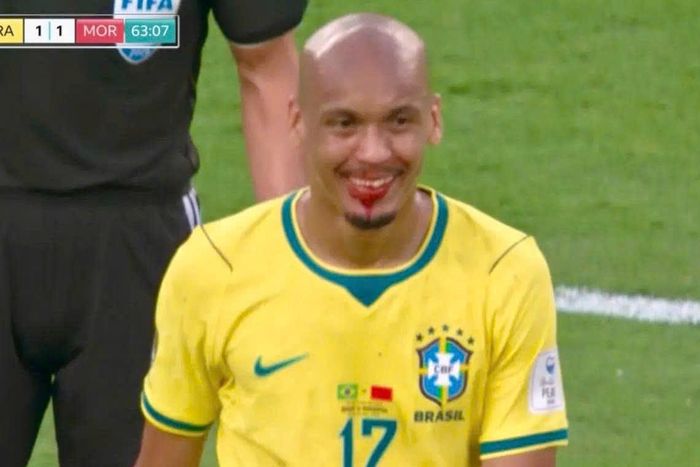 Fabinho bị chảy máu và phải tạm thời rời sân đấu. Ảnh: BBC.
