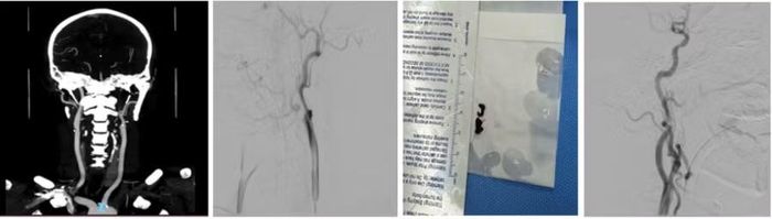 Động mạch cảnh trong trước can thiệp (trái) và sau can thiệp (phải) lấy huyết khối kèm đặt stent.