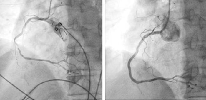 Động mạch vành phải trước và sau can thiệp đặt stent.