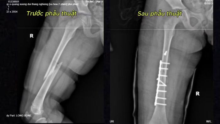 Xương gãy trên phim chụp trước và sau phẫu thuật - Ảnh BVCC