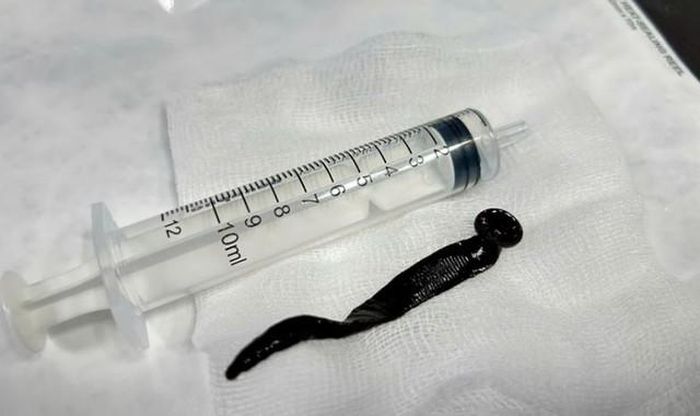 Các bác sĩ đã thực hiện nội soi gắp thành công một con đỉa còn sống, dài khoảng 12cm, nằm tại vị trí ngã ba khí quản của bệnh nhi 8 tuổi. Ảnh: báo Quân đội nhân dân