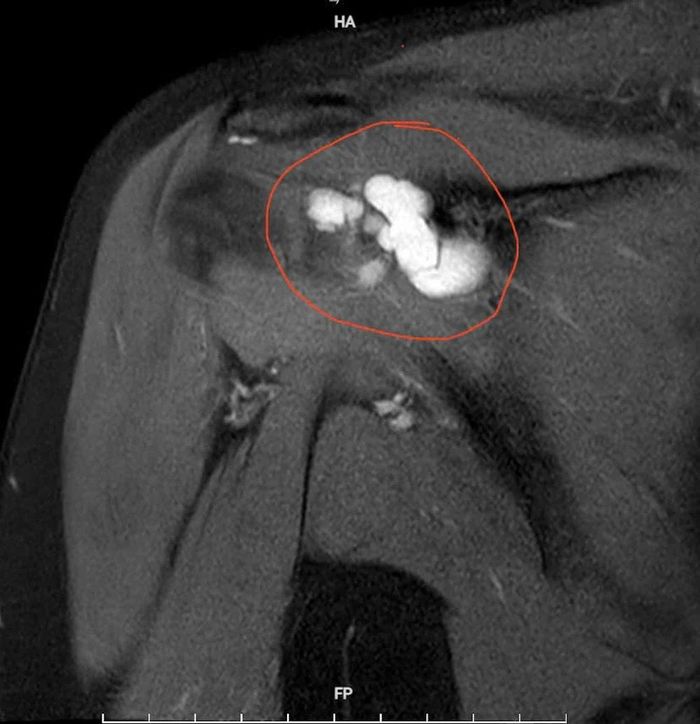 Hình ảnh chụp cộng hưởng từ (MRI) khối u kích thước khoảng 4×2 cm gây hẹp khoang mỏm cùng vai, chèn ép các cấu trúc xung quanh.