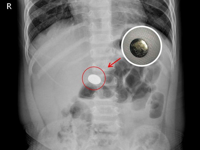 Hình ảnh dị vật pin cúc áo trong dạ dày của bé N.M.H