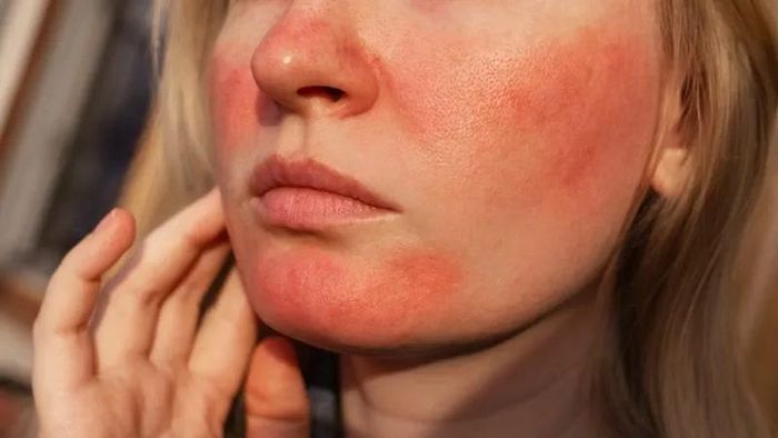 Làn da trở nên nhạy cảm hơn bình thường, dễ bị kích ứng, cháy nắng khi không được che chắn kỹ