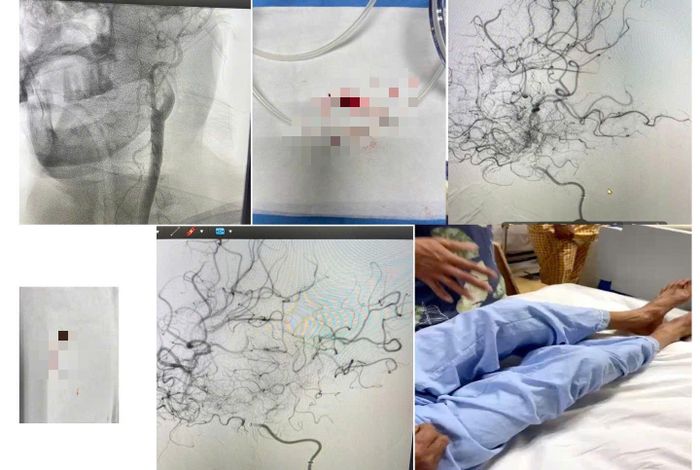 Bệnh nhân nam nhập viện do đột quỵ tắc mạch.