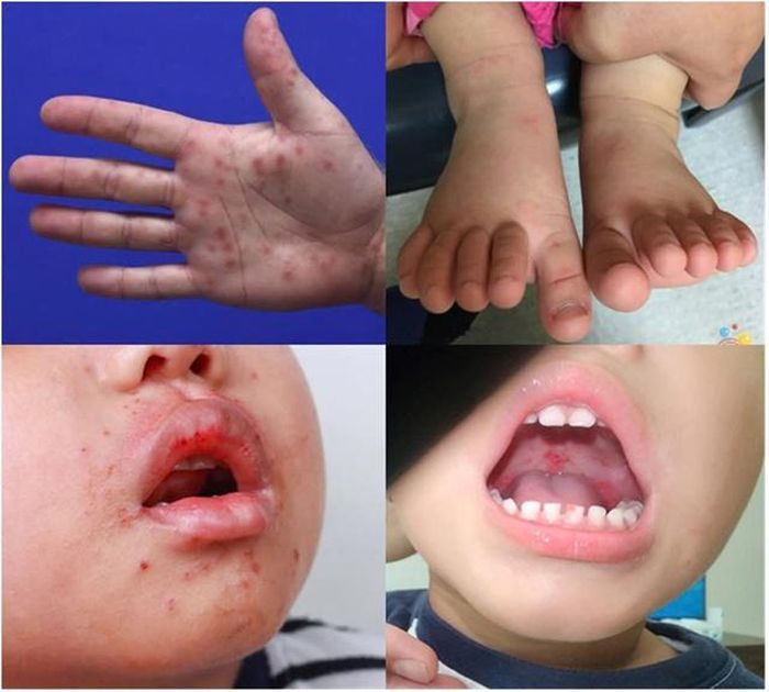 Các dấu hiệu điển hình của bệnh tay chân miệng ở trẻ. Ảnh: BVCC.