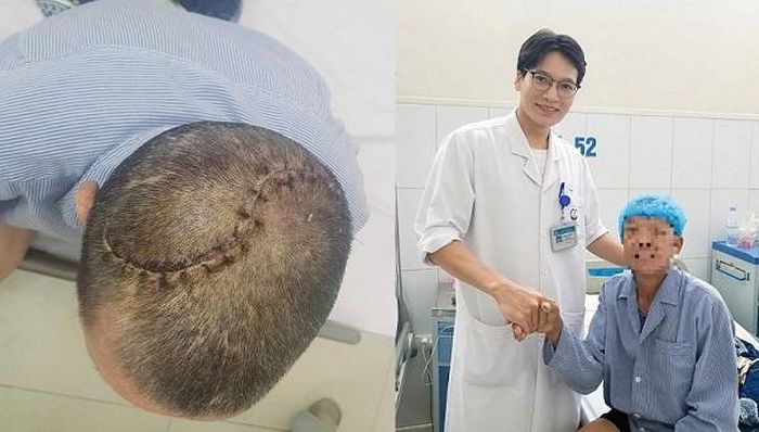 Hình ảnh vết mổ sau ca phẫu thuật sọ não của bệnh nhân N.V.B. Và hình ảnh bệnh nhân N.V.B phục hồi sau ca mổ, dự kiến xuất viện hôm nay (17/6). Ảnh Trần Lâm.