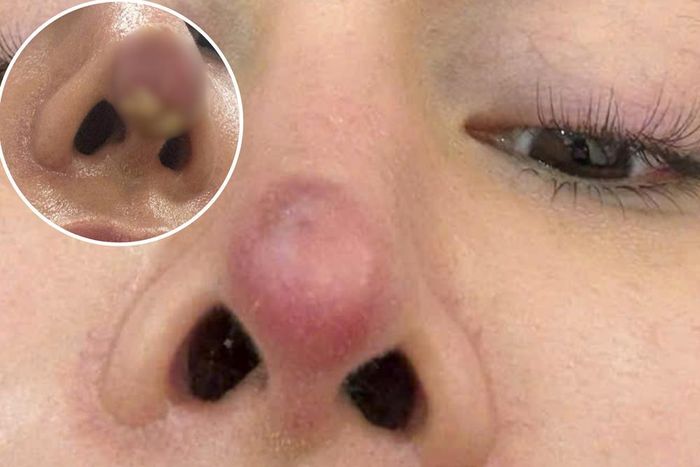 Tin vào những lời quảng cáo trên không gian mạng, khách hàng tìm đến dùng dịch vụ và sau đó là những tổn thương vùng mũi sau phẫu thuật thẩm mỹ