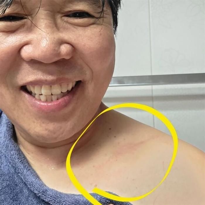 Sau khi phẫu thuật xương đòn, Jung Eun Pyo tiếp tục phải đối mặt với hàng loạt cơn đau khác trong quá trình hồi phục.