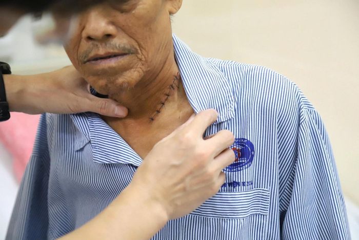 Người bệnh được nạo vét triệt để khối u, tạo hình thực quản sau điều trị hóa xạ trị. Ảnh: BVCC