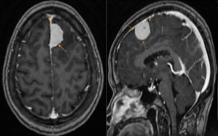 Hình ảnh khối u được phát hiện trên phim chụp MRI.