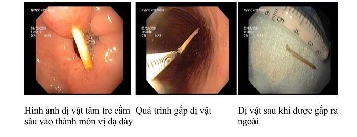 Một số trường hợp dị vật nằm trong đường thở lâu ngày còn có thể gây viêm phổi tái diễn, áp xe phổi.
