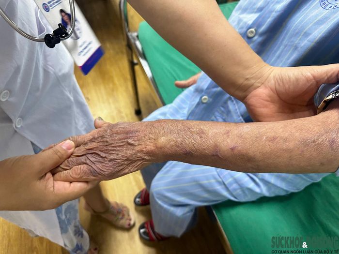 Nhiều bệnh nhân nhập viện trong tình trạng suy tuyến thượng thận, tăng đường huyết hoặc nhiễm trùng nặng do lạm dụng corticoid kéo dài.