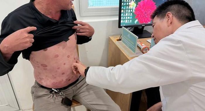Giám đốc BV Da liễu Trung ương PGS.TS Lê Hữu Doanh, khám cho bệnh nhân.