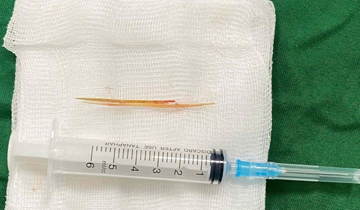 Chiếc tăm tre được lấy ra khỏi gan người bệnh qua đường rạch da nhỏ, giúp tránh một cuộc phẫu thuật lớn.