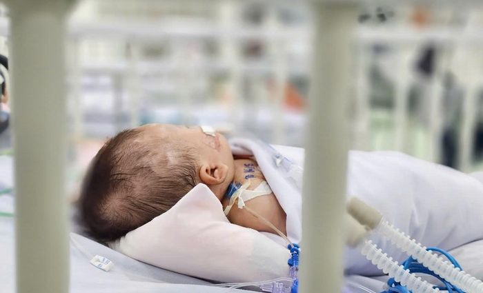  Nhiều bệnh nhi sốc sốt xuất huyết nặng phải thở máy. Ảnh: Nguyễn Thuận.