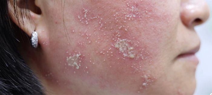Kiến ba khoang cắn gây các vết bỏng rát trên da