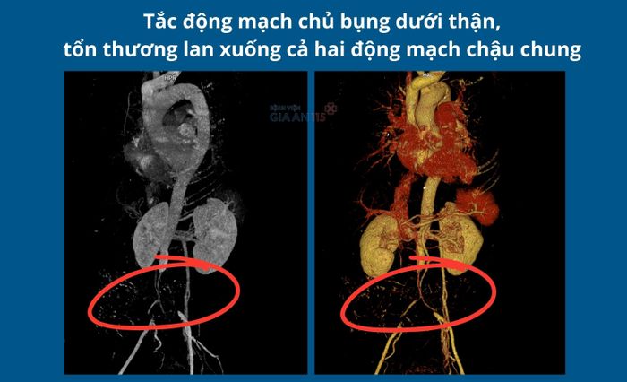  Vị trí tắc động mạch chủ - chậu 