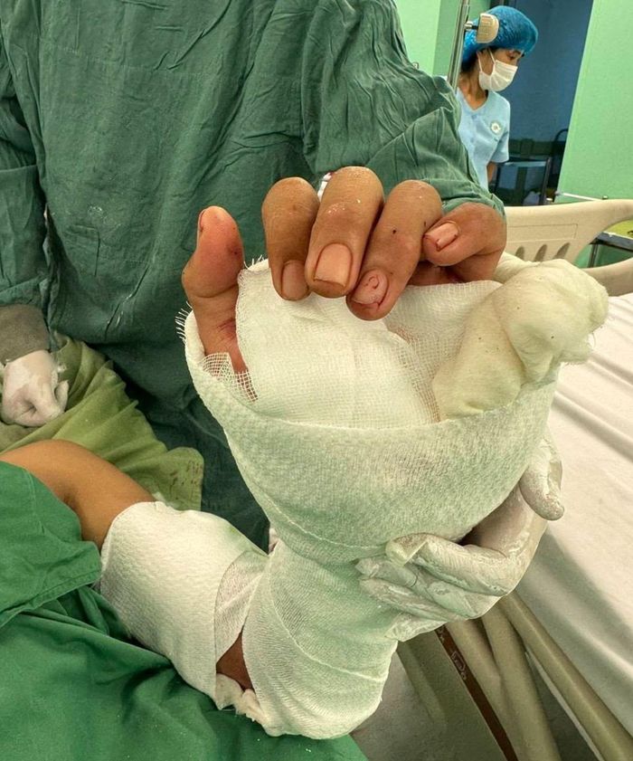 Bàn tay bệnh nhân sau 2 ngày được nối lại. Ảnh: Thanh Nga