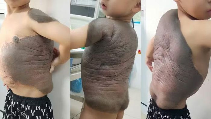 Cậu bé mang trên mình khối u rất lớn